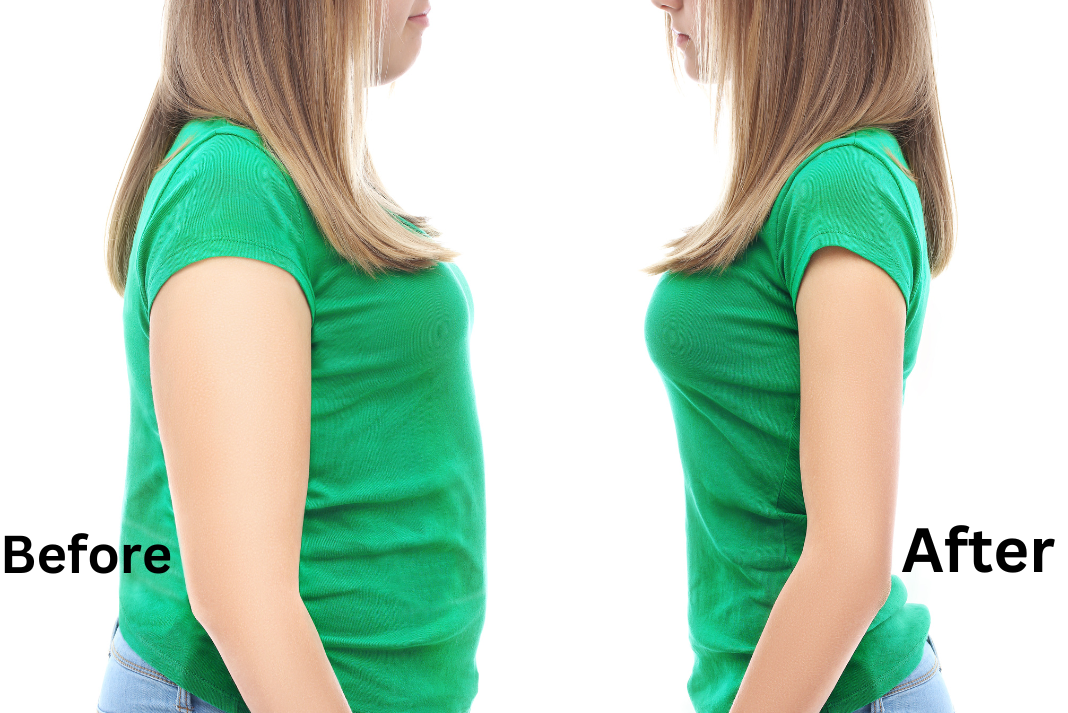 Understanding the Dangers of Gone Wrong Cool Sculpting Before And After